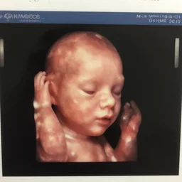ultrasound portrait of fetus
