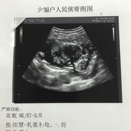 an ultrasound picture from a pregnancy scan