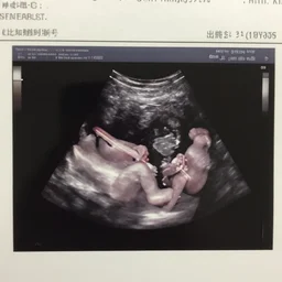 ultrasound of fetus