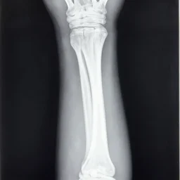 real radiological ray - x of a fracture of the femur.