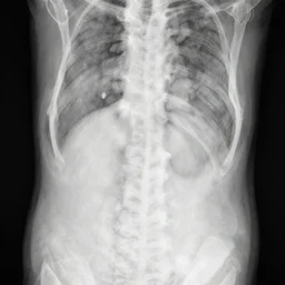 X ray photograph of a chronic appendicitis