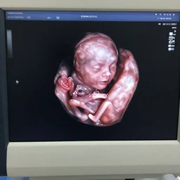 medical ultrasound of a human fetus